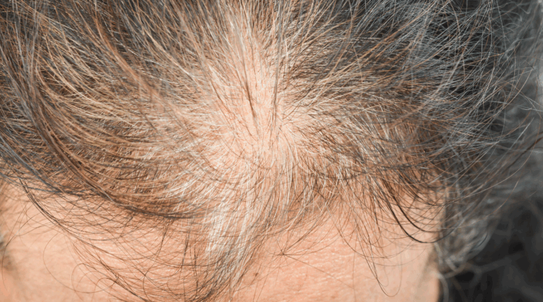 Close-up of a person's scalp showing signs of hair thinning and early-stage hair loss, often treated with regenerative therapies like polynucleotides, exosomes, and microneedling.