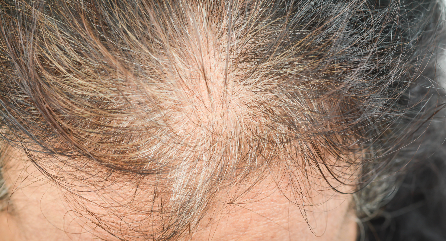 Stimulate Stronger Hair Growth with Polynucleotides, Exosomes, and Microneedling