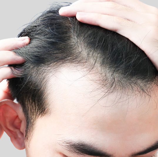 Man with thinning hairline before non-surgical hair restoration using polynucleotides, exosomes, and microneedling