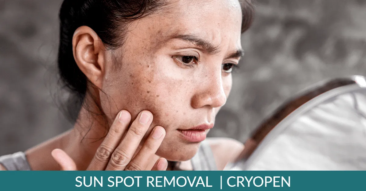 Why live with sun spots? Remove them with Cryopen
